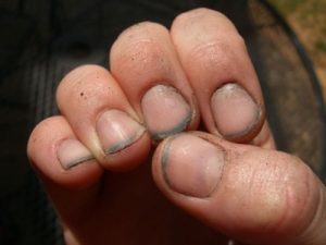 Грязные ногти