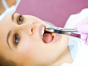Удаление в стоматологии