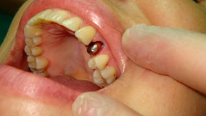 К чему снятся коронки зубов выпадают — Выпали коронки зубные сонник