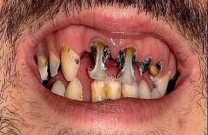 Гнилые зубы